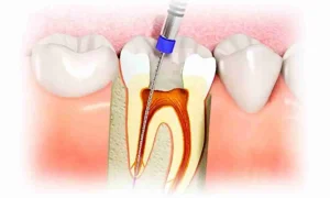 endodoncia en Barcelona