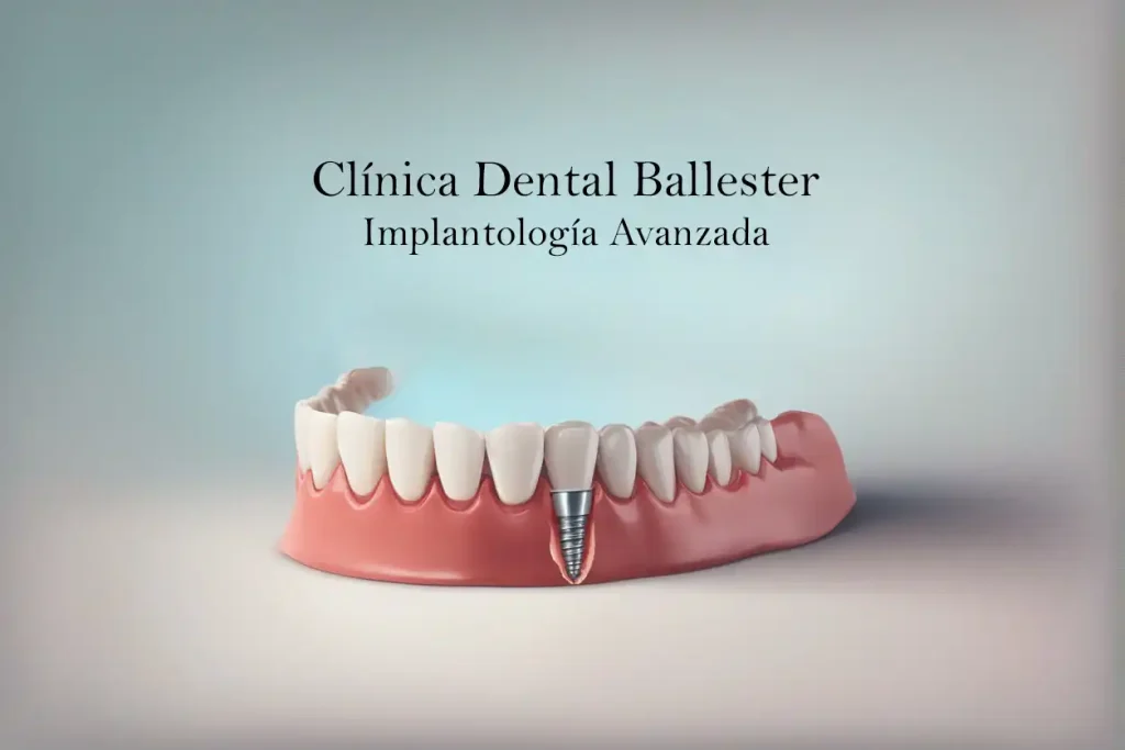 Implantes dentales en Viladecans
