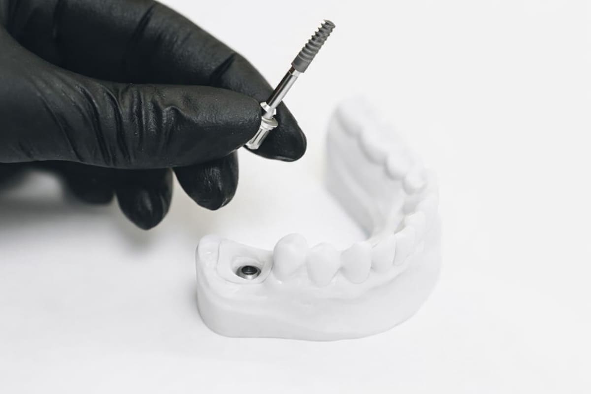 Implantes dentales para pacientes con poco hueso Implantes dentales para pacientes con poco hueso