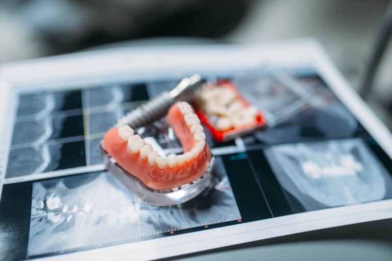tipos de prótesis dentales