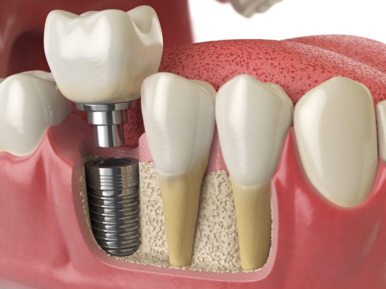 implantes de carga inmediata
