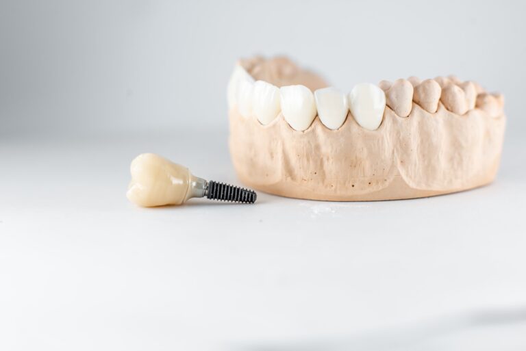 implantes dentales