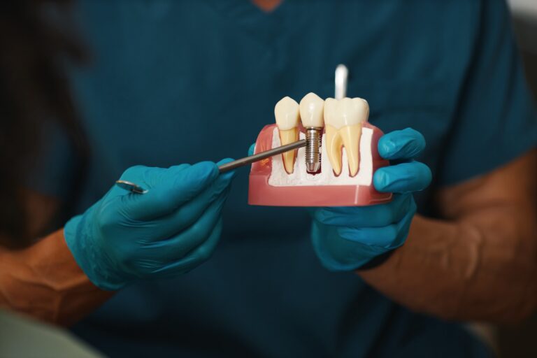 cicatrizar los implantes dentales