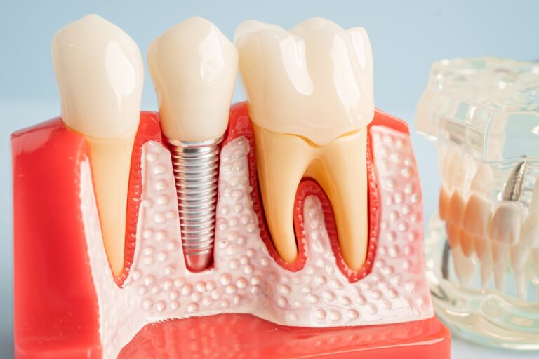 problemas pueden ocasionar los implantes dentales
