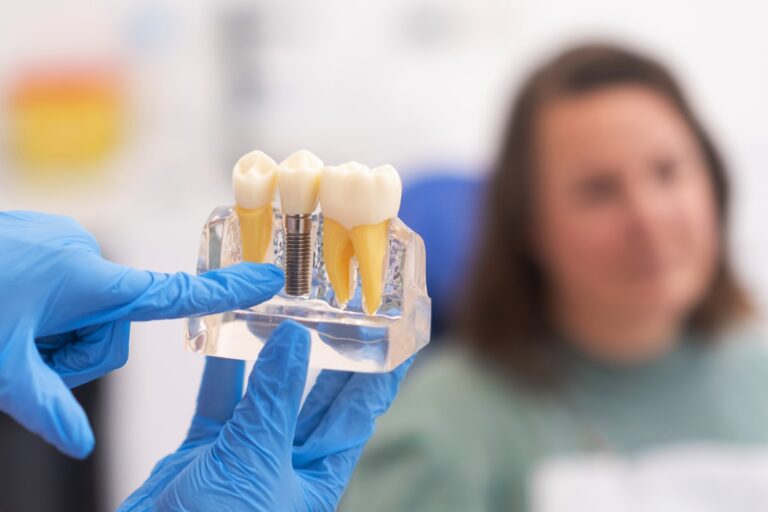 implantes dentales