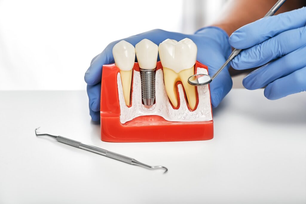 cuánto dura un implante dental