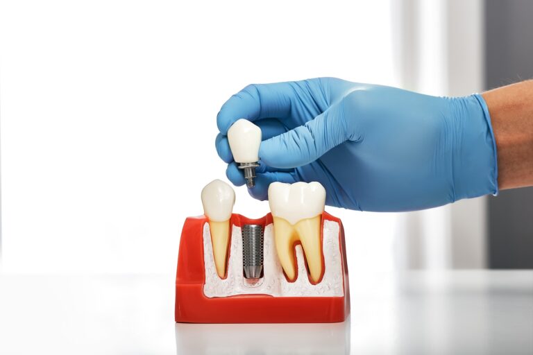 fracasar un implante dental