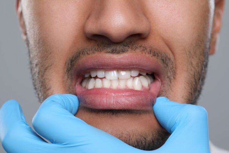dientes apiñados