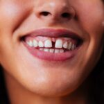 separación entre dientes