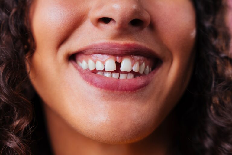 separación entre dientes